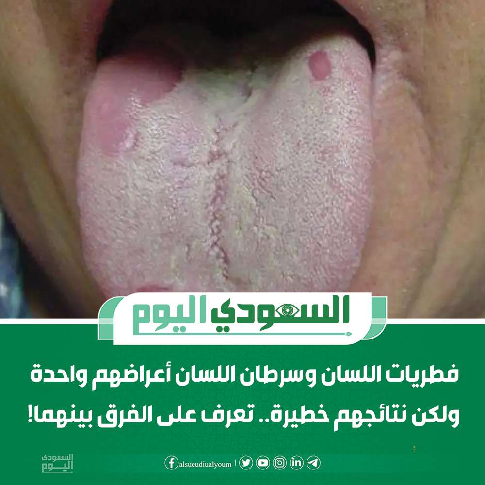 فطريات اللسان وسرطان اللسان: أعراض متشابهة وعواقب مختلفة.. كيف تفرق بينهما؟